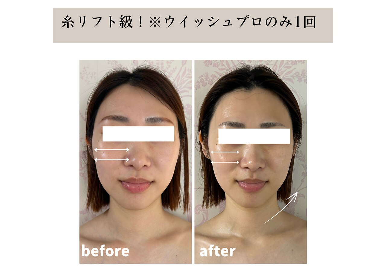 ⭐️美容器⭐️ラジオ波 インディバ SET RET痛み緩和 美品 大阪市近郊