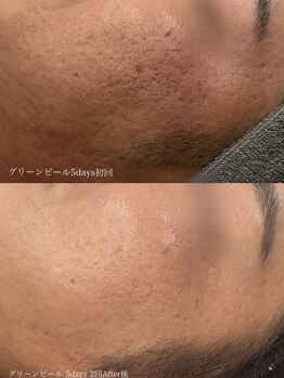 ウルト アルティメイトスキン(ULT ultimate skin)/グリーンピール最強です