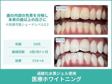 クレア(Crea)/【歯のホワイトニング症例写真】
