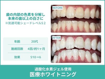 クレア(Crea)/【歯のホワイトニング症例写真】