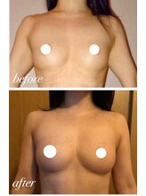 美人バスト アンド ヒップアップ 広島店/バストアップ症例写真