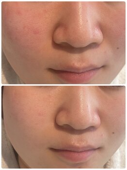 ピュア 川越店/ニキビ徹底ケアコース