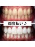 【都度払い(単発)】セルフホワイトニング20分照射×2回　¥6,980