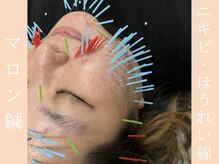 健志接骨院/マロン鍼