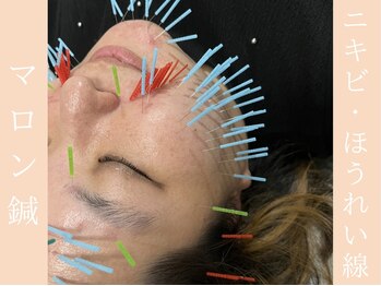 健志接骨院/マロン鍼