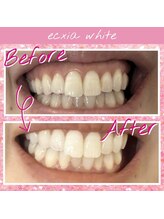 エクシアホワイトニング 都城店/ホワイトニングビフォーアフター