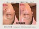 ベリンダ(BELINDA)の写真/【剥離/ダウンタイムなし】次世代低刺激ピーリング☆お肌を育てて根本改善＜ラミネーションピール＞