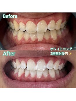 サロン ベレッツァ(Salon Bellezza)/ホワイトニング施術例