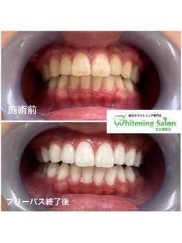 ホワイトニングサロン 名古屋駅店/【ホワイトニング施術例】