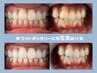【ホワイトニング回数券】実は1番お得な12回コース★今だけ3回分プレゼント！