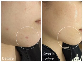 ラミーユ(La Miu)/【２週間後の変化】肌質改善京都