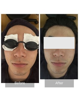 ダンニヒル(dannihil)/【小顔矯正】20代学生3回目