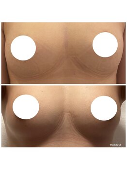 ルミエール(Lumiere)/【倉敷市】バストアップ施術事例