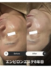 リマイン(Re mine)/濃いシミも肌全体を美白に