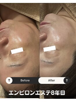 リマイン(Re mine)/濃いシミも肌全体を美白に