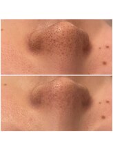 メゾンリュバン 天王寺(Maison Ruban)/毛穴洗浄・美白フォト|毛穴ケア