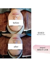 ココ センガ ビューティー クリニック(COCO SENGA Beauty-Clinic)/ジェットピール　ハリ/ツヤ