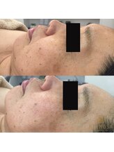 エメ 心斎橋(Aimer)/グリーンハーブピーリング効果