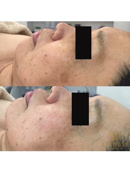 エメ 心斎橋(Aimer)/グリーンハーブピーリング効果