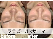 マドモアゼル 麻布十番/ララピール×サーマ