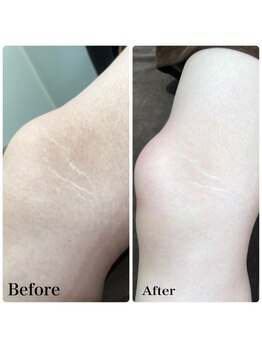 バニーヒップ(Bunny Hip)/カーボキシー