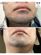 エヌココ(N_coco)/最短で濃い毛にアプローチ！