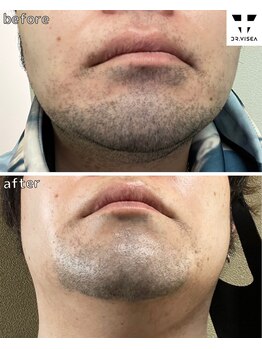 エヌココ(N_coco)/最短で濃い毛にアプローチ！