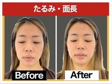 エレヴィザ トウキョウ 恵比寿院(ELVISA TOKYO)/エラの張り・たるみが気になる