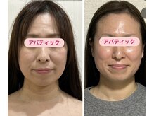 アバティック(ABatick)/小顔コルギの効果