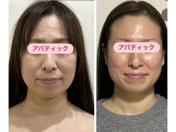 アバティック(ABatick)/小顔コルギの効果