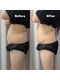 クレール 小山店(CLAIR)の写真/【大人気のピーチリフトをBODYにも！！】シワに！たるみに！しっかり引き上げて見ためスッキリ！