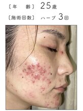 ノーブル 新宿南口(NOBLE)/ハーブピーリング専門新宿