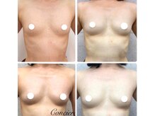 美人バスト アンド ヒップアップ 広島店/バストアップ症例写真