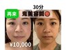 【驚異の小顔実感！】ルート鬼美容鍼30分¥10000