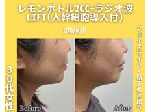 イーラボ 池袋店(e-LABO)/レモンボトル+ラジオ波Lift