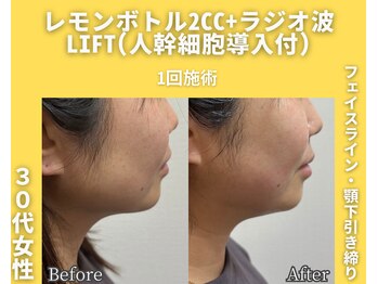 イーラボ 池袋店(e-LABO)/レモンボトル+ラジオ波Lift