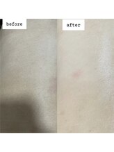 ウィズティ(with.T)/背中Wax