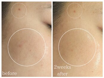 ラミーユ(La Miu)/【二週間後の変化】肌荒れ改善