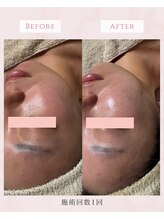 リチェルカ(Ricerca)/肌リセットBEFORE→AFTER