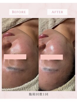 リチェルカ(Ricerca)/肌リセットBEFORE→AFTER