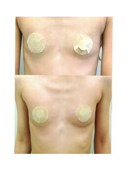 ルミエール(Lumiere)/【倉敷市】バストアップ施術事例