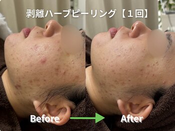 リソルバイスリール(Re:sol by sourire)/毛穴洗浄・ハーブピーリング専門