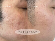 ビジュー(bjyou)/フェイシャルエステ