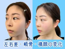 ナチュラルパーフェクトフェイス 新宿/小顔で横顔美人に/新宿小顔矯正