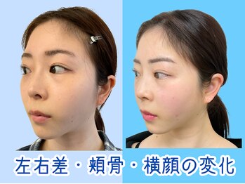 ナチュラルパーフェクトフェイス 新宿/小顔で横顔美人に/新宿小顔矯正