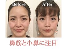 ラプリ 浜松店(Raplit)/ 隆鼻＋輪郭矯正40分10回