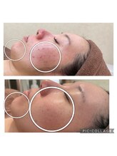 トータルエステティックサロン ラ レーヌ(La Reine)/お肌の土台を整えて美肌へ