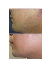 エム(M)/ひげ脱毛