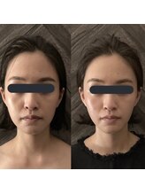 ハイコガオ 中崎町店(HIKOGAO)/小顔矯正