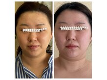 ディアナ(La Grand Belle Diana)の雰囲気（脂肪分解レモンボトル結果の出方がすごい！ソフトダーマ施術5回）